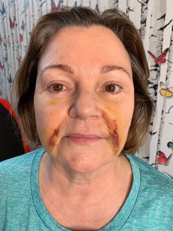 Woman with bruising on face | before and after nano cellcare treatments