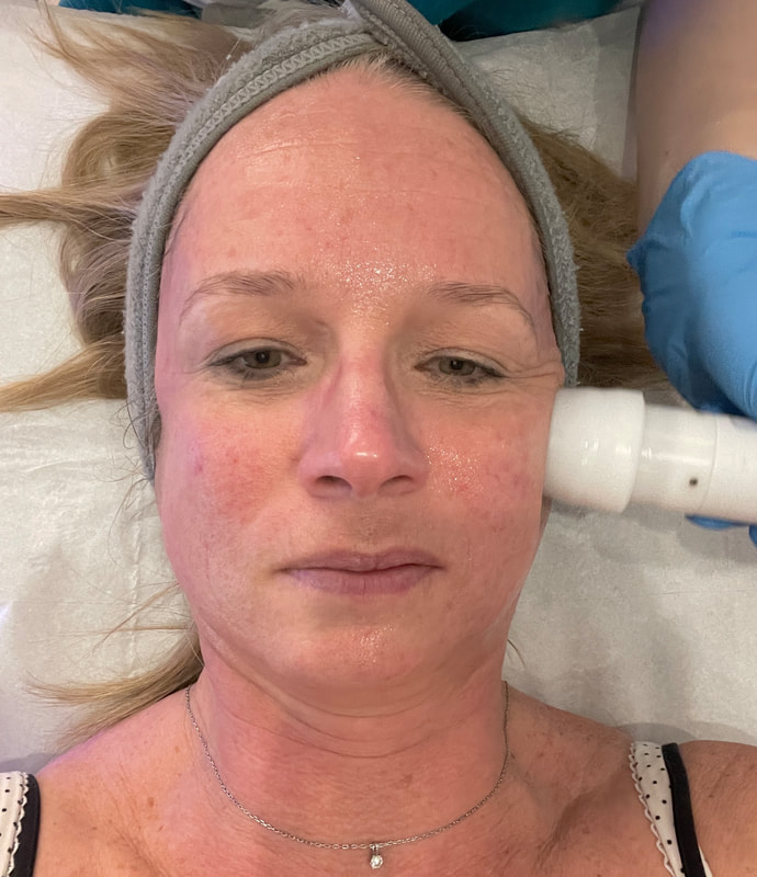 Woman having a radio frequency treatment at ERA Skin & Laser Clinic, Thame